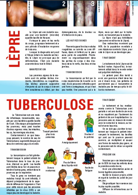 Saúde lança folder educativo de hanseníase e tuberculose em francês