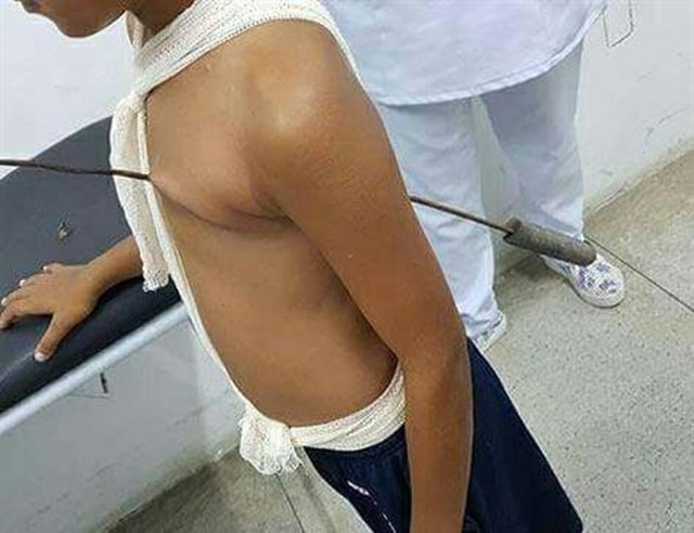 Menino teve o corpo perfurado com espeto de churrasco (Foto: Reprodução/Whatsapp)