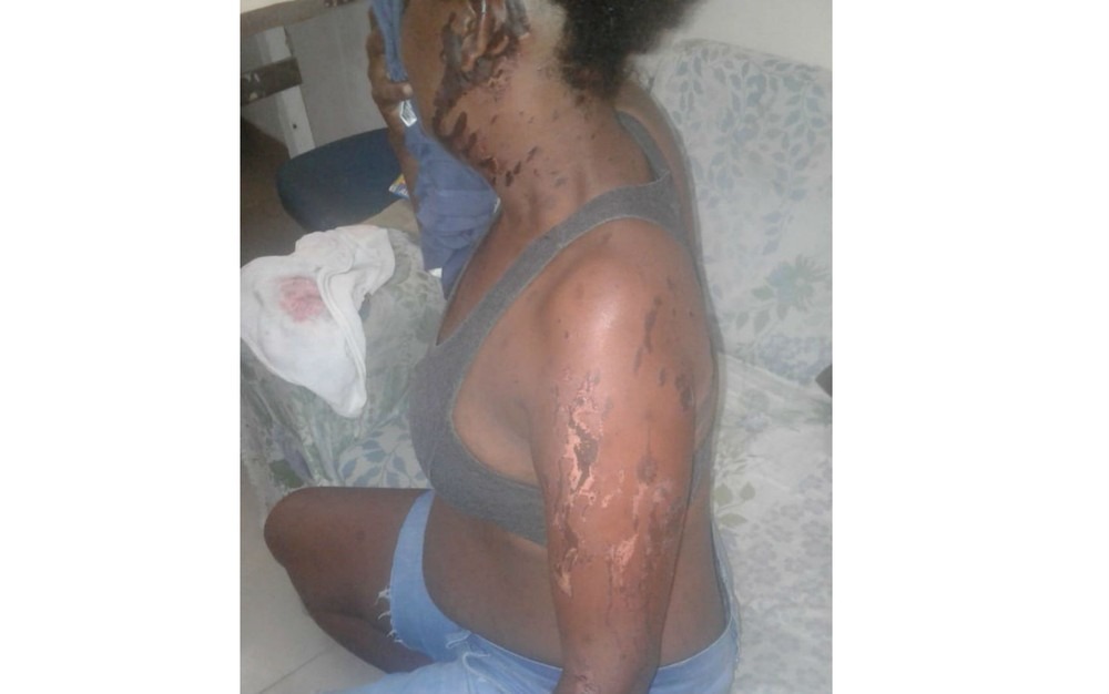 Vítima foi queimada com ácido por ex-namorado após término de relacionamento (Foto: Arquivo pessoal)
