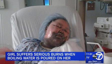 Menina de 11 anos fica desfigurada após ser acordada com água fervendo