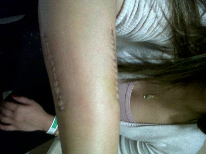 Estudante quebrou o braço em dois lugares, tendo que implantar pinos (Foto: cedida) 