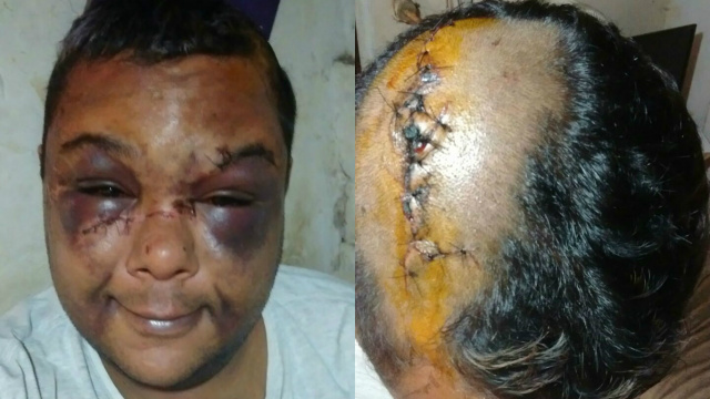 ‘’Saímos para matar veado’’, diziam agressores de homossexual em Três Lagoas Imagens de Caio registradas nesta terça-feira (13). (Foto: Arquivo pessoal).