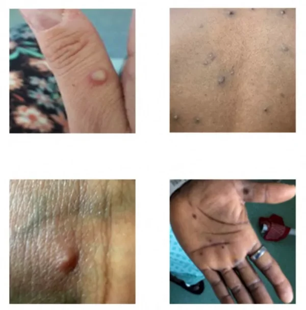Três Lagoas registra os dois primeiros casos suspeitos de Varíola Monkeypox Três Lagoas registra os dois primeiros casos suspeitos de Varíola Monkeypox