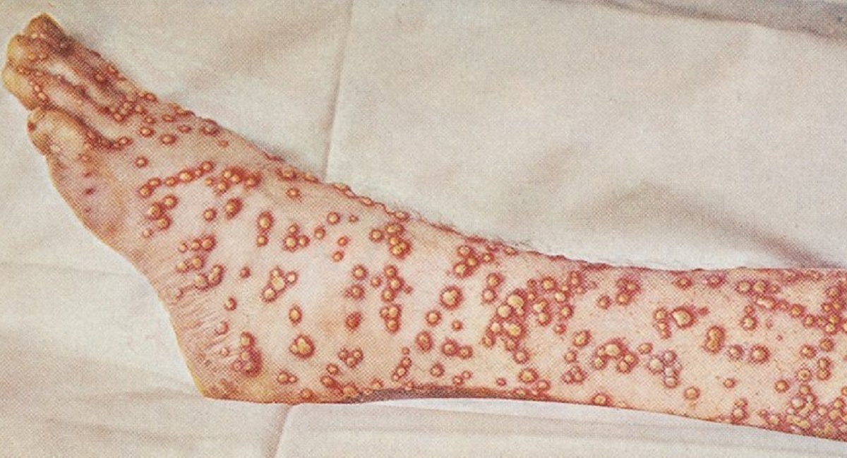 Brasil tem oitava morte por varíola dos macacos confirmada