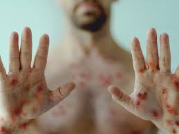 Ministério da Saúde amplia testagem de varíola dos macacos