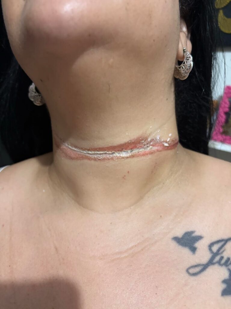 Professora quase é enforcada por cabos de internet em Três Lagoas Professora quase é enforcada por cabos de internet em Três Lagoas