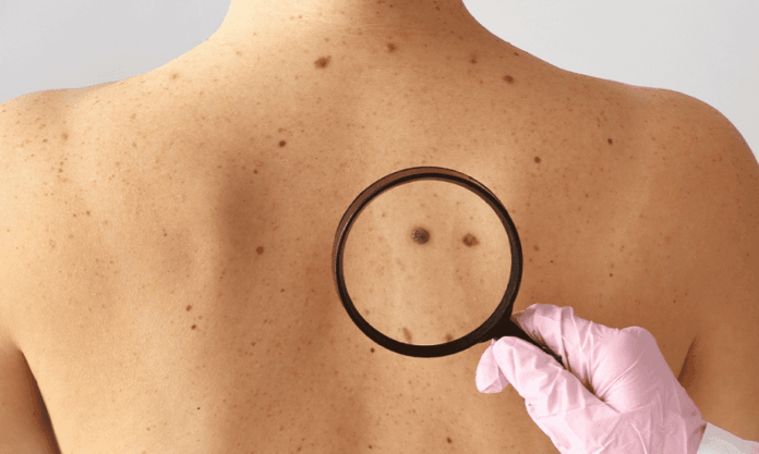 SMS proporciona mutirão dermatológico em alusão a campanha “Dezembro Laranja”