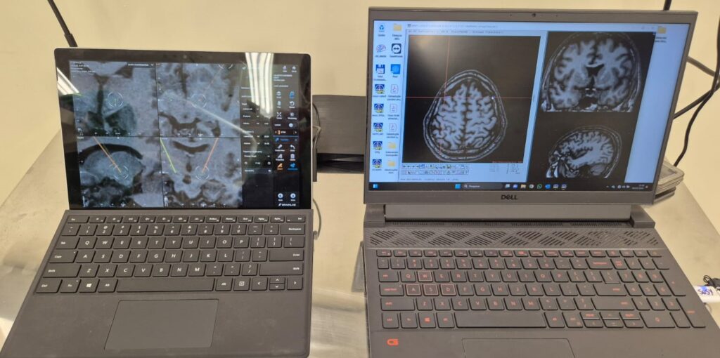 Hospital Regional da Costa Leste de Três Lagoas realiza primeira cirurgia cerebral pelo SUS para tratar Parkinson em MS