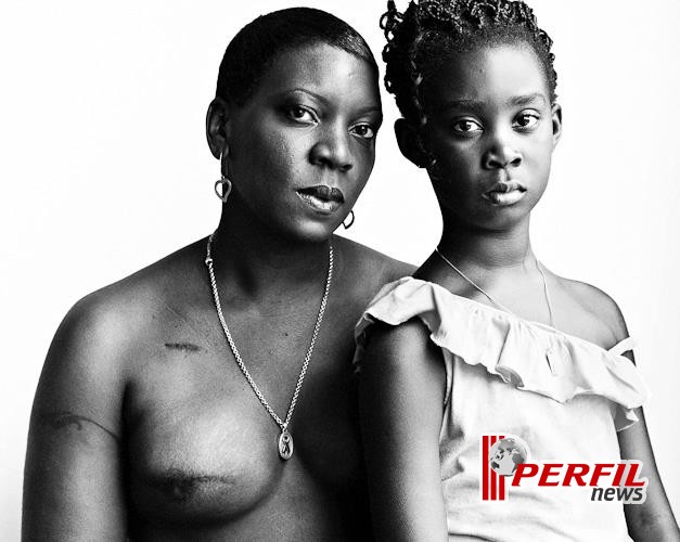 Fotos chocantes mostram realidade de mulheres que passaram por mastectomia