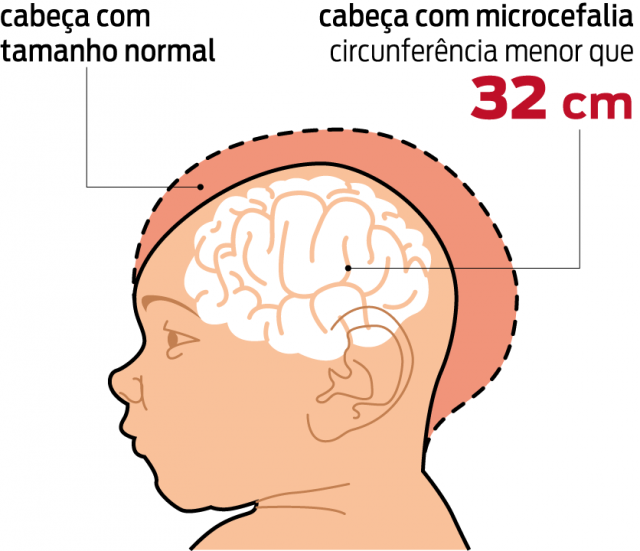 1.168 casos de microcefalia foram confirmados em todo o país Do total de casos de microcefalia confirmados, 192 tiveram resultado positivo para o Zika por critério laboratorial específico para o vírus. (Foto: Divulgação)