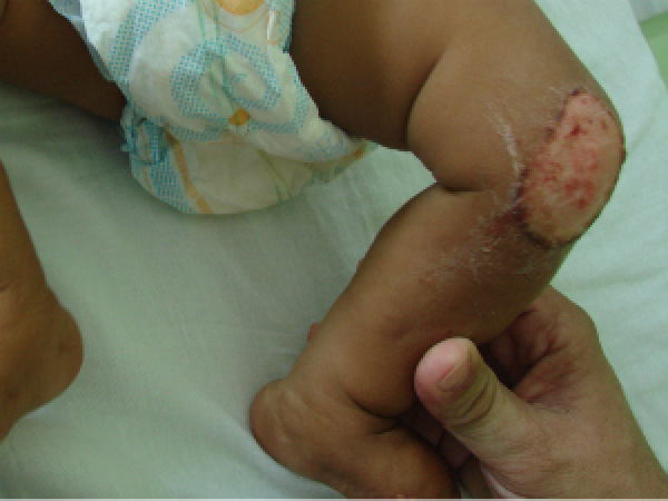 Mãe é suspeita de maus-tratos contra bebê de seis meses, diz polícia em MS Lesão no joelho do bebê de 6 meses
Foto: Divulgação/Polícia Civil