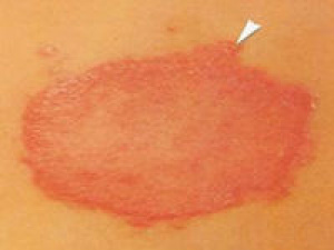 Manchas vermelhas na pele é um dos sintomas da doença. Foto: Divulgação