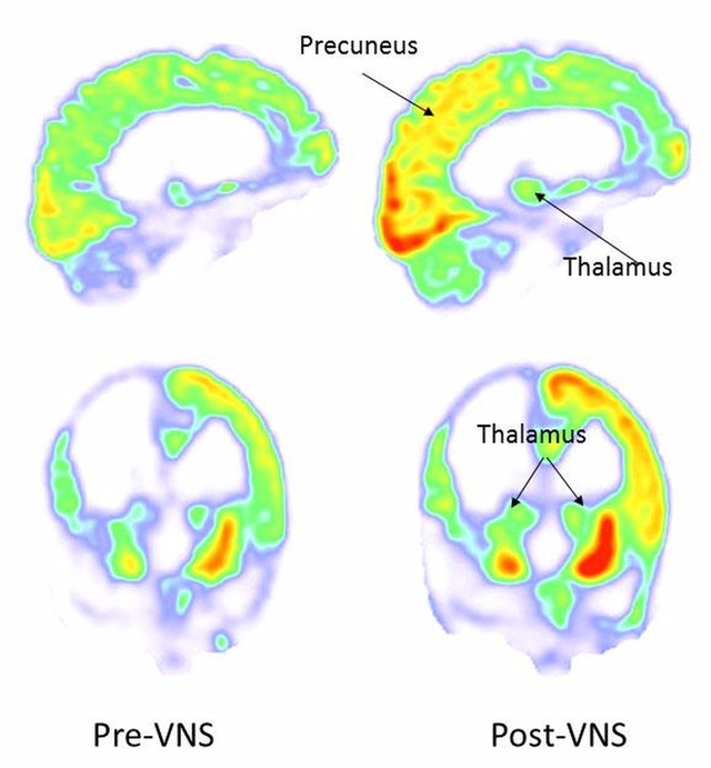 Imagem mostra cérebro de homem antes e após estimulação. Partes 'alaranjadas' indicam aumento da atividade cerebral e metabolismo (Foto: Corazzol et al./Current Biology)