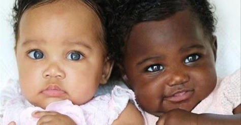 Gêmeas com cor de pele diferente fazem sucesso na web