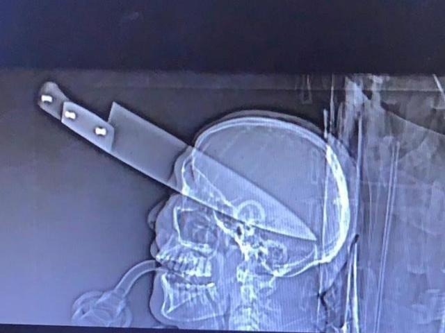 Facada no olho dividiu cérebro e homem está em estado gravíssimo A vítima foi encontrada em um carro na Rua Buriti, no bairro Estrela Tovi (Foto: Sidnei Bronka/Ligado na Notícia)
