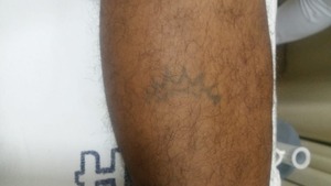 Hospital procura família de homem internado em estado grave A outra tatuagem é na perna. Foto: Divulgação HNSA.