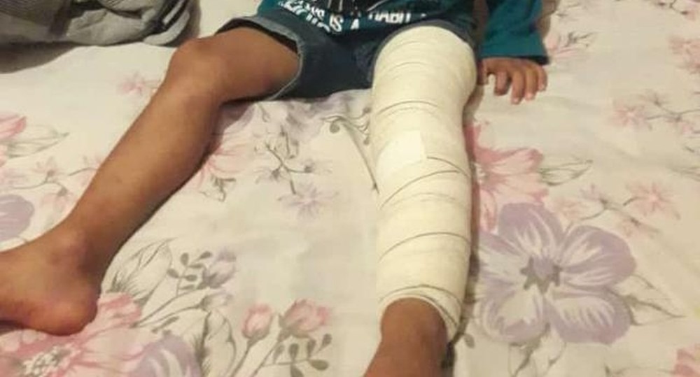Após passar por tratamento em hospital, criança de cinco anos cai de ambulância e fica ferida Menino de cinco anos sofreu lesão em uma das pernas (Foto: Yhara de Fátima de Souza Lopes/Cedida)