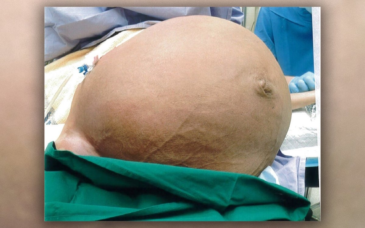 Médicos retiram tumor de 27 kg do útero de mulher em Singapura Médicos retiram tumor de 27 kg do útero de mulher em Singapura