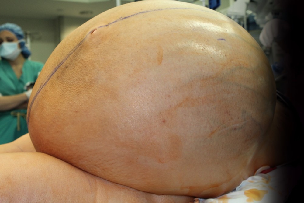 Tumor de quase 60kg no ovário de mulher nos Estados Unidos (Foto: Danbury Hospital, Danbury, CT, USA)
