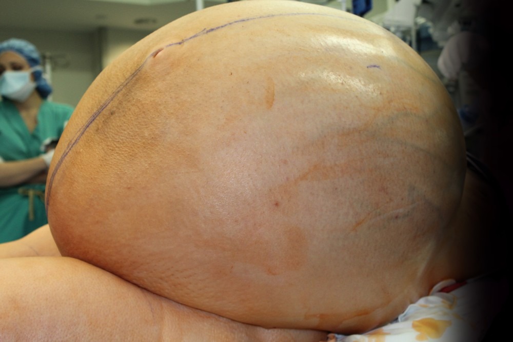 Médicos retiram tumor de 27 kg do útero de mulher em Singapura Tumor de quase 60kg no ovário de mulher nos Estados Unidos (Foto: Danbury Hospital, Danbury, CT, USA)