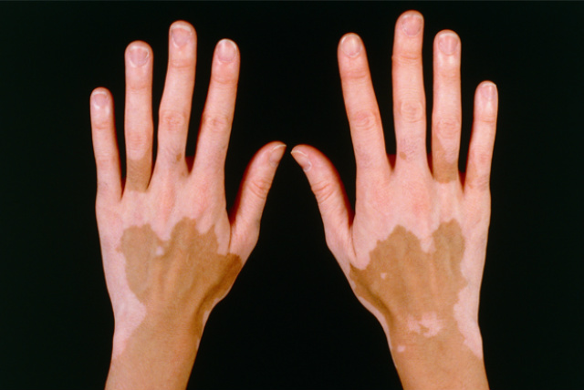 Vitiligo tem cura, mas não é possível predizer quem vai se curar, porque cada pessoa reage de seu jeito próprio. (Foto: Divulgação)