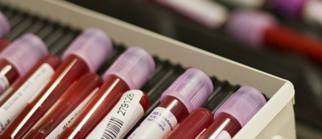 SUS oferece novo exame para Hepatite C previsão é que o novo exame esteja disponível para os usuários do SUS em até 180 dias (Foto:Reprodução)