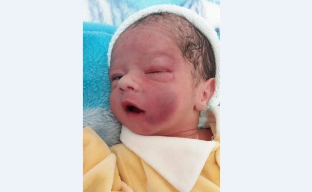Bebê Nicolas, com o rosto coberto de hematomas após um parto normal. Foto: Arquivo da família