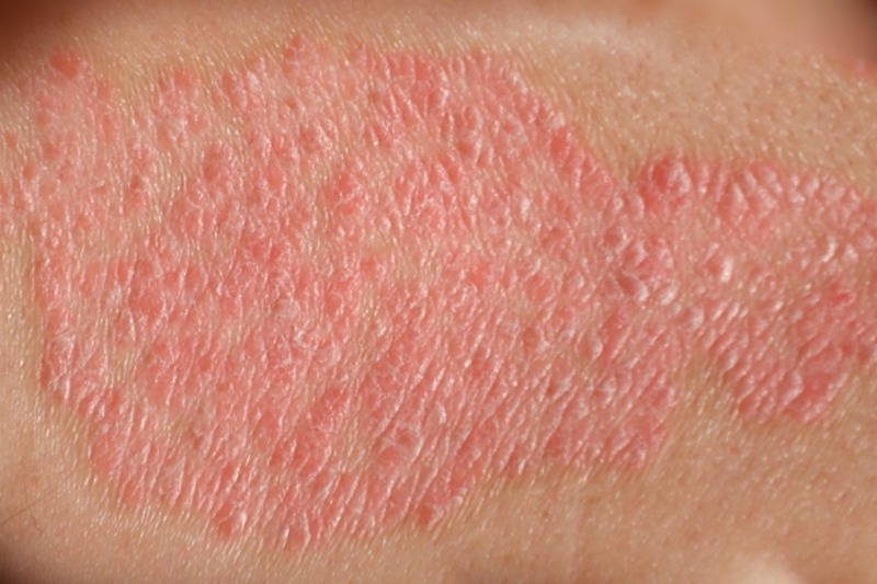 SUS oferece quatro novos medicamentos contra psoríase Foto: site Sociedade Brasileira de Dermatologia