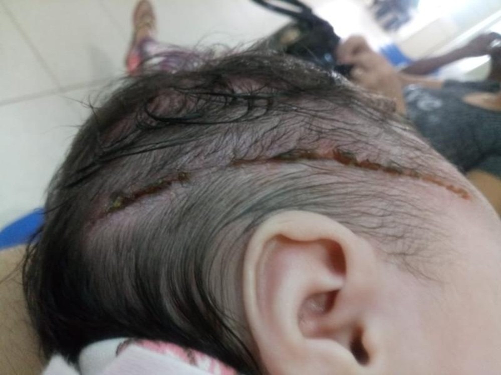 Bebê levou 25 pontos na cabeça após corte causado por bisturi durante parte em Araçatuba (SP) — Foto: Arquivo pessoal

