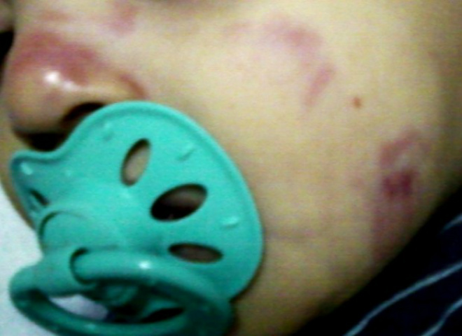 Criança de um ano e dois meses apresenta diversos hematomas na região do rosto (Foto: Nova News)
