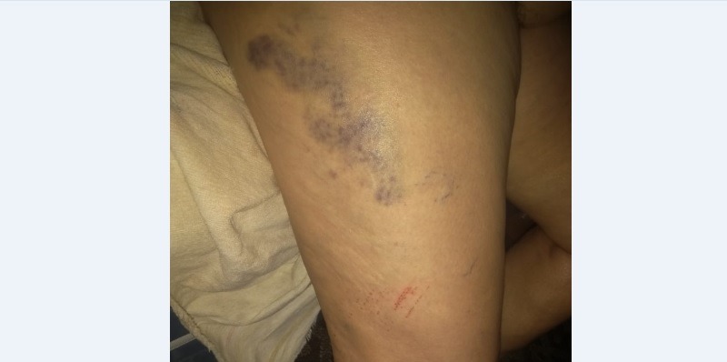 Idosa de 72 anos e o filho são agredidos por suposto autor que divulgou video de sexo em Três Lagoas Senhora de 72 anos também foi agredida; além das marcas físicas ela guarda o trauma e está a base de calmantes. Foto: Arquivo Pessoal