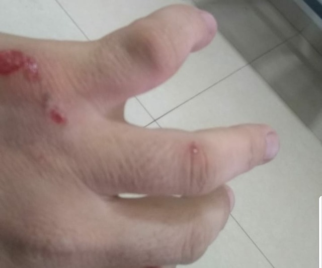 Vítima agredida por suposto autor de vídeo de sexo vende TV para se sustentar Mecânico teve a mão quebrada pelo suposto autor do vídeo de sexo e não pode trabalhar. Foto: Arquivo Pessoal