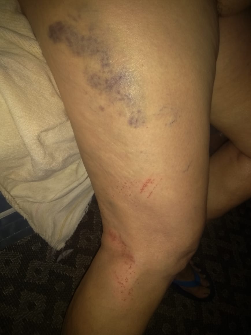 Vítima agredida por suposto autor de vídeo de sexo vende TV para se sustentar A perna da mãe de Ednaldo ficou cheia de hematomas. Foto: Arquivo Pessoal