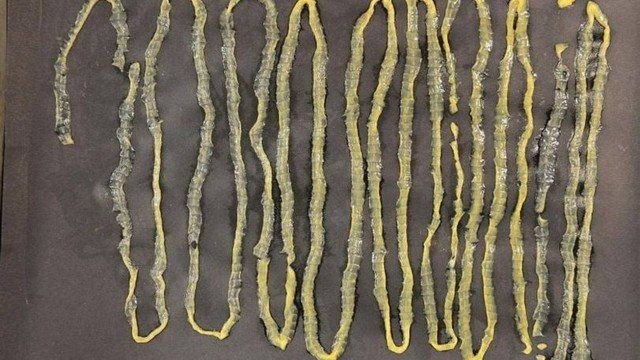 Encontrada solitária de 2,8 metros no estômago de fã de sushi Tênia de 2,8 metros achada no estômago de paciente em Cingapura Foto: Divulgação/Singapore General Hospital (SGH) - Department of Microbiology