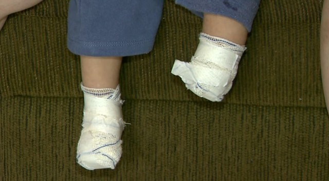 Bebê tem pé e pontas dos dedos amputados após ser internado com pneumonia Miguel teve o pé esquerdo amputado após ser internado com pneumonia na Santa Casa de Franca, SP (Foto: Reprodução/EPTV)