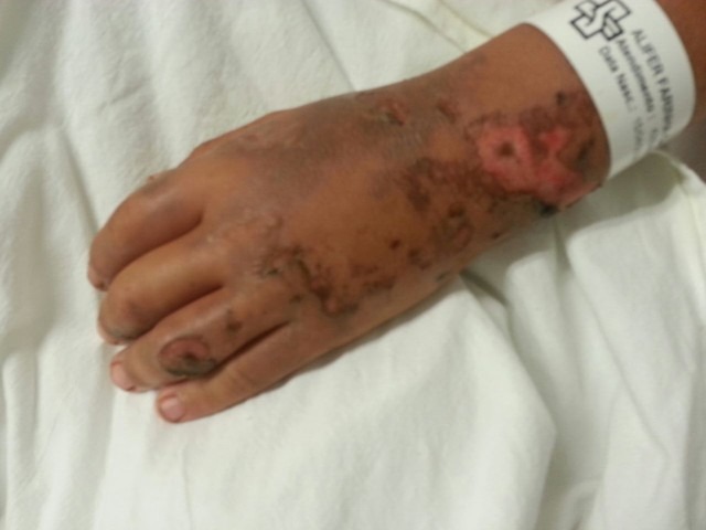 Menino leva choque de alta-tensão ao soltar soltar pipa com fio de cerca elétrica Menino de 11 anos teve ferimentos em diversas partes do corpo após choque (Foto: Danúbia Rolon/Arquivo Pessoal)
