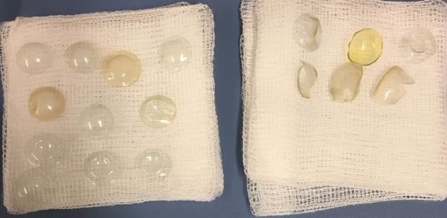 Médicos encontram 27 lentes de contato em olho de paciente Lentes retiradas de olho de idosa | Reprodução da internet/ British Medical Journal