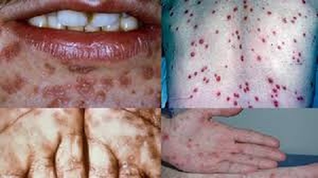 Saúde alerta população sobre cuidados e prevenção da epidemia de sífilis Somente no mês de junho, foram registrados cinco casos de sífilis congênita (Assessoria de Comunicação)