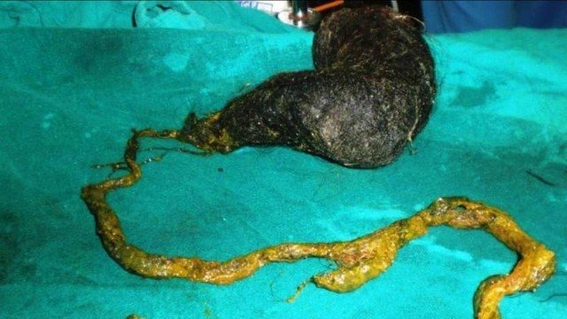 Médicos removem massa de fios de cabelo de 1,1 metro do estômago de paciente Massa de cabelo retirada do estômago de paciente indiana Foto: Reprodução/British Medical Journal