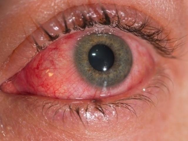 Zika não matou em 2018, mas casos subiram 265% em MS Vermelhidão nos olhos sem secreção é um dos sintomas. (Foto: Reprodução/Internet)