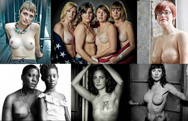 Fotos chocantes mostram realidade de mulheres que passaram por mastectomia Diferente das campanhas tradicionais, onde uma camiseta com um alvo e uma fita rosa formando um laço são os símbolos da campanha, as fotos mostram o lado real do câncer da mama com imagens de mulheres que passaram por mastectomia (Fotos: David Jay)