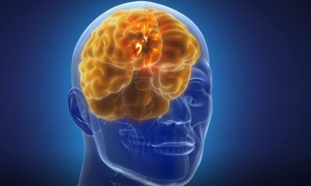 Mal de Parkinson: o marcapasso cerebral que promete acabar com tremores e convulsões causados pela doença Aparelho monitora a atividade cerebral em 128 pontos ao mesmo tempo, o que o diferencia de dispositivos existentes hoje — Foto: Reprodução/BBC