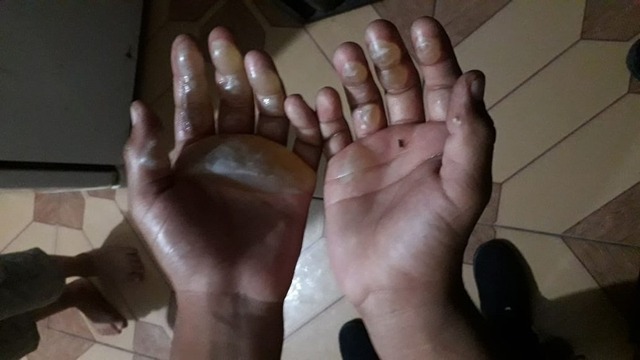 Criança de 9 anos tem mãos queimadas com ferro de passar e mãe será indiciada por tortura Criança de 9 anos ficou com mãos tomadas por bolhas da queimadura com ferro de passar roupa — Foto: Arquivo Pessoal